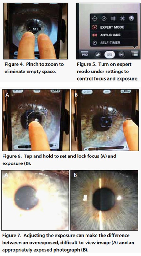 slit lamp procamera iphone, ophthalmology iphone app photo, eye photo iphone, procamera ophthalmologist, procamera app